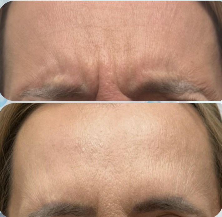 efekt przed i po dla zbiegu medycyny estetycznej dla czoła