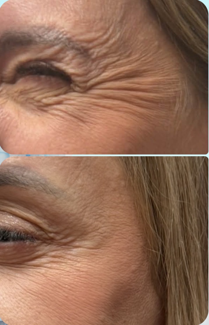 efekt przed i po dla zbiegu medycyny estetycznej