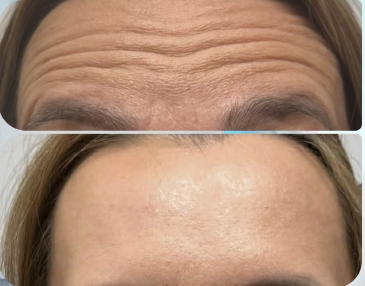 efekt przed i po dla zbiegu medycyny estetycznej dla czoła