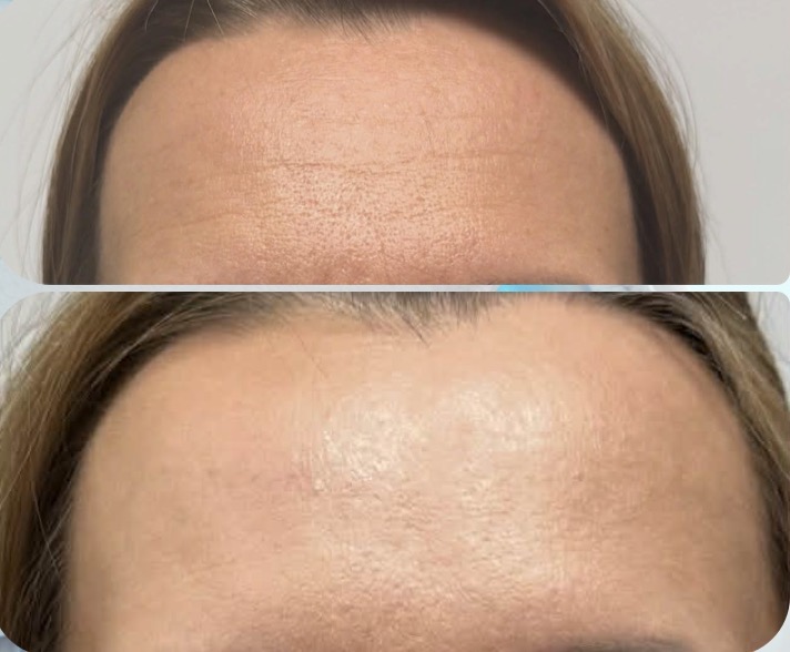 efekt przed i po dla zbiegu medycyny estetycznej dla czoła