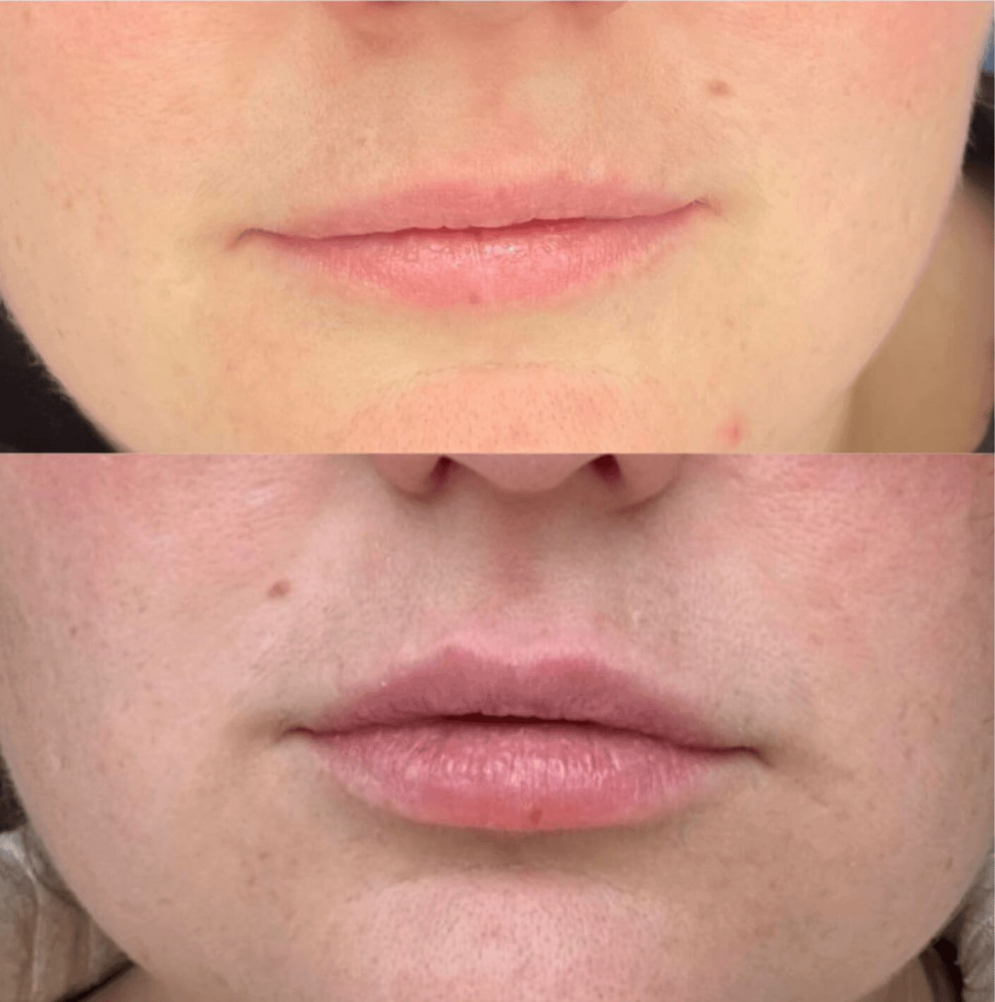 efekt przed i po dla zbiegu medycyny estetycznej dla ust