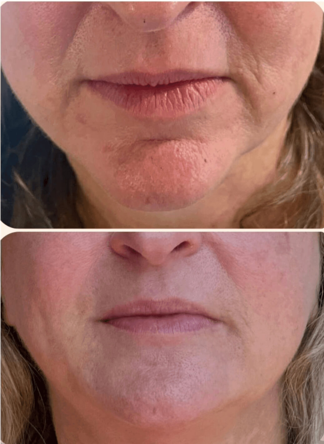 efekt przed i po dla zbiegu medycyny estetycznej dla ust
