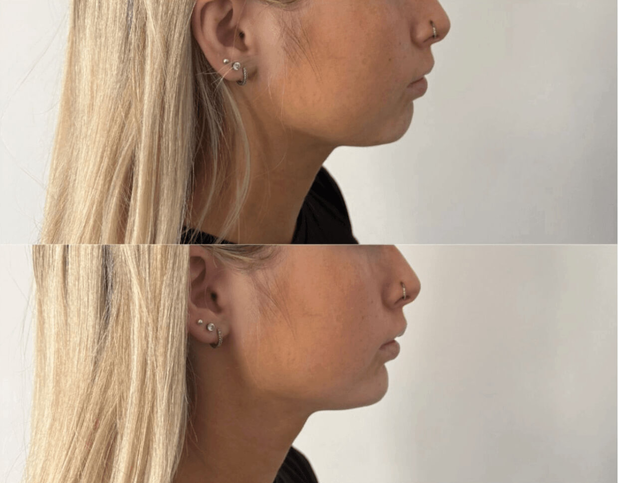 efekt przed i po dla zbiegu medycyny estetycznej