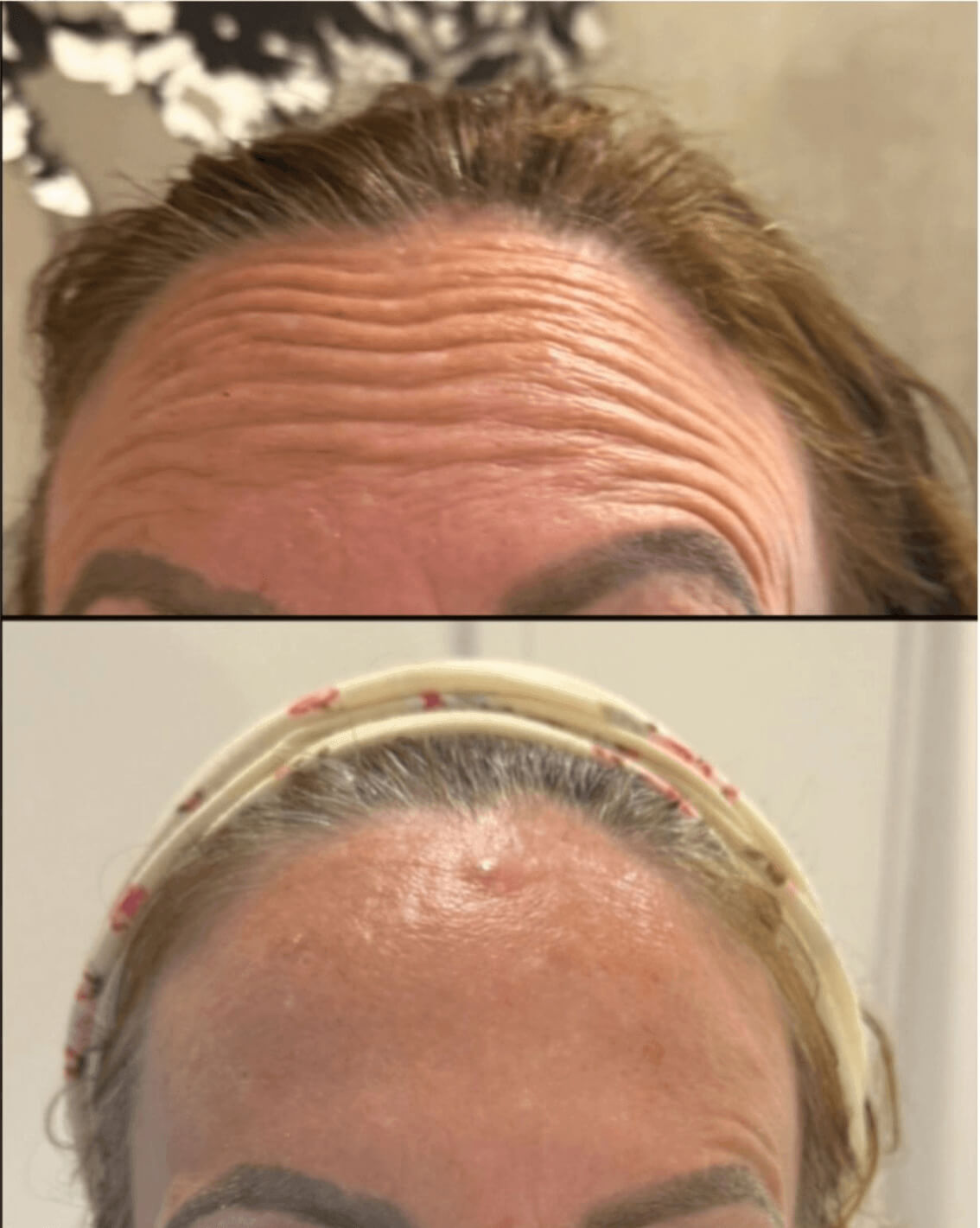 efekt przed i po dla zbiegu medycyny estetycznej dla czoła