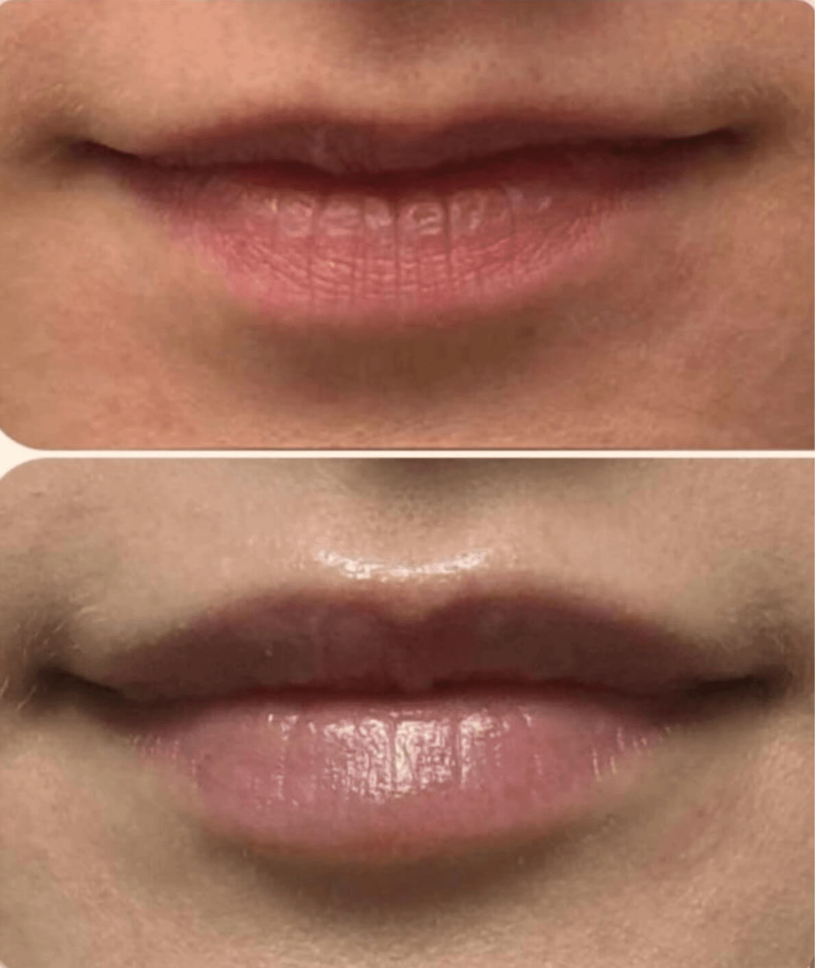 efekt przed i po dla zbiegu medycyny estetycznej dla ust