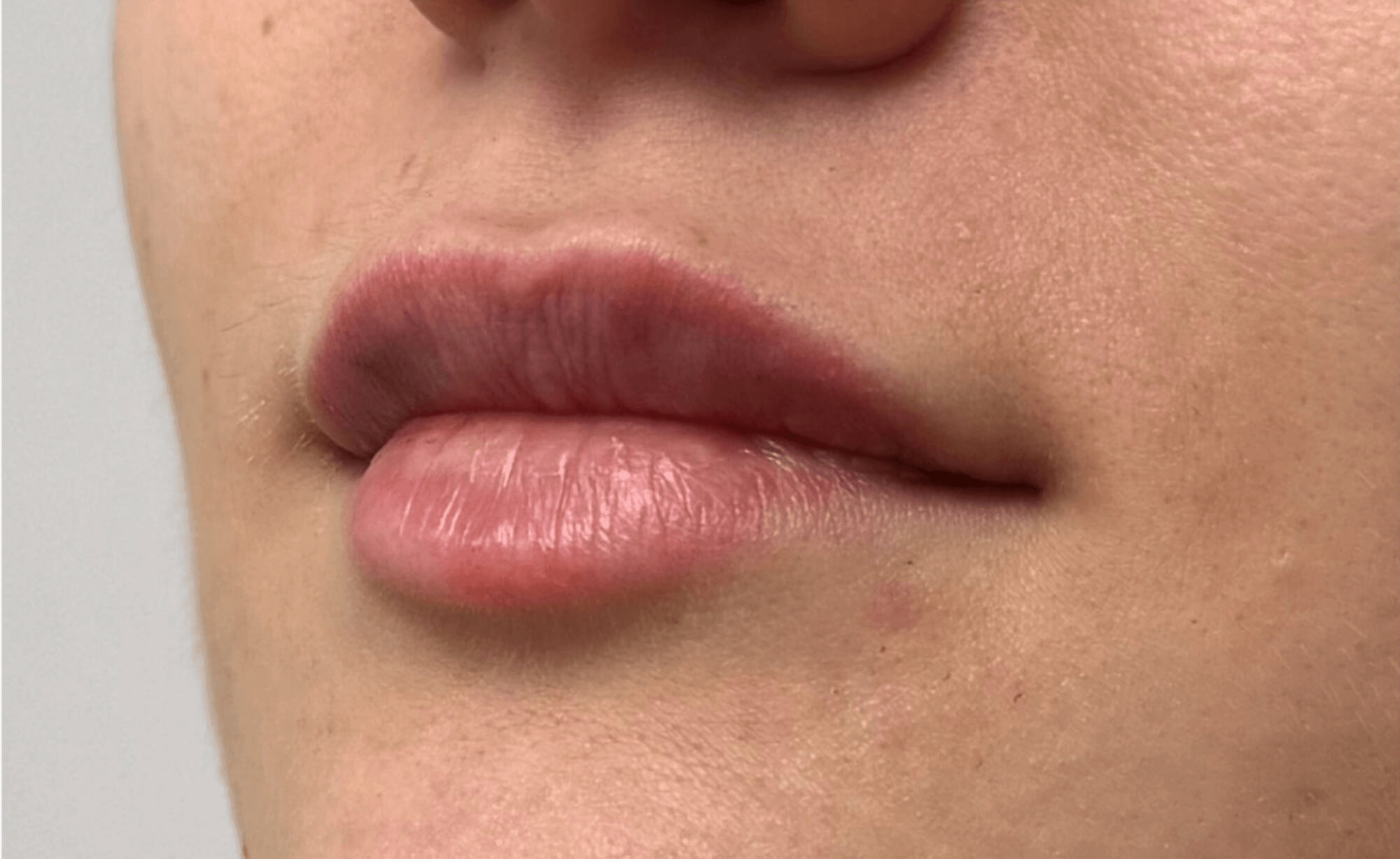 efekt medycyny estetycznej dla ust