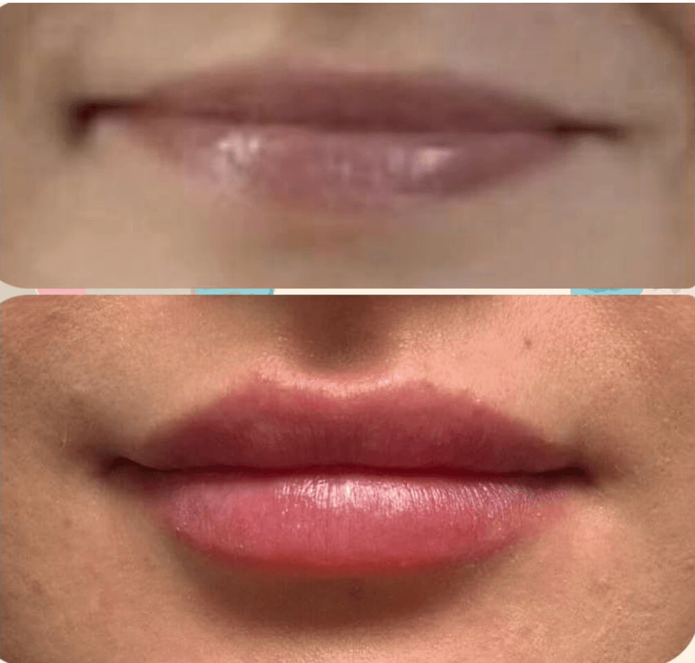 efekt przed i po dla zbiegu medycyny estetycznej dla ust