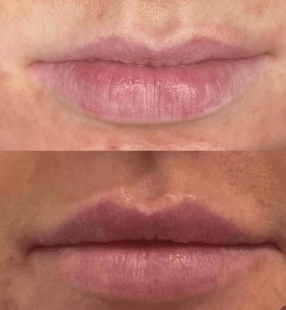 efekt przed i po dla zbiegu medycyny estetycznej dla ust