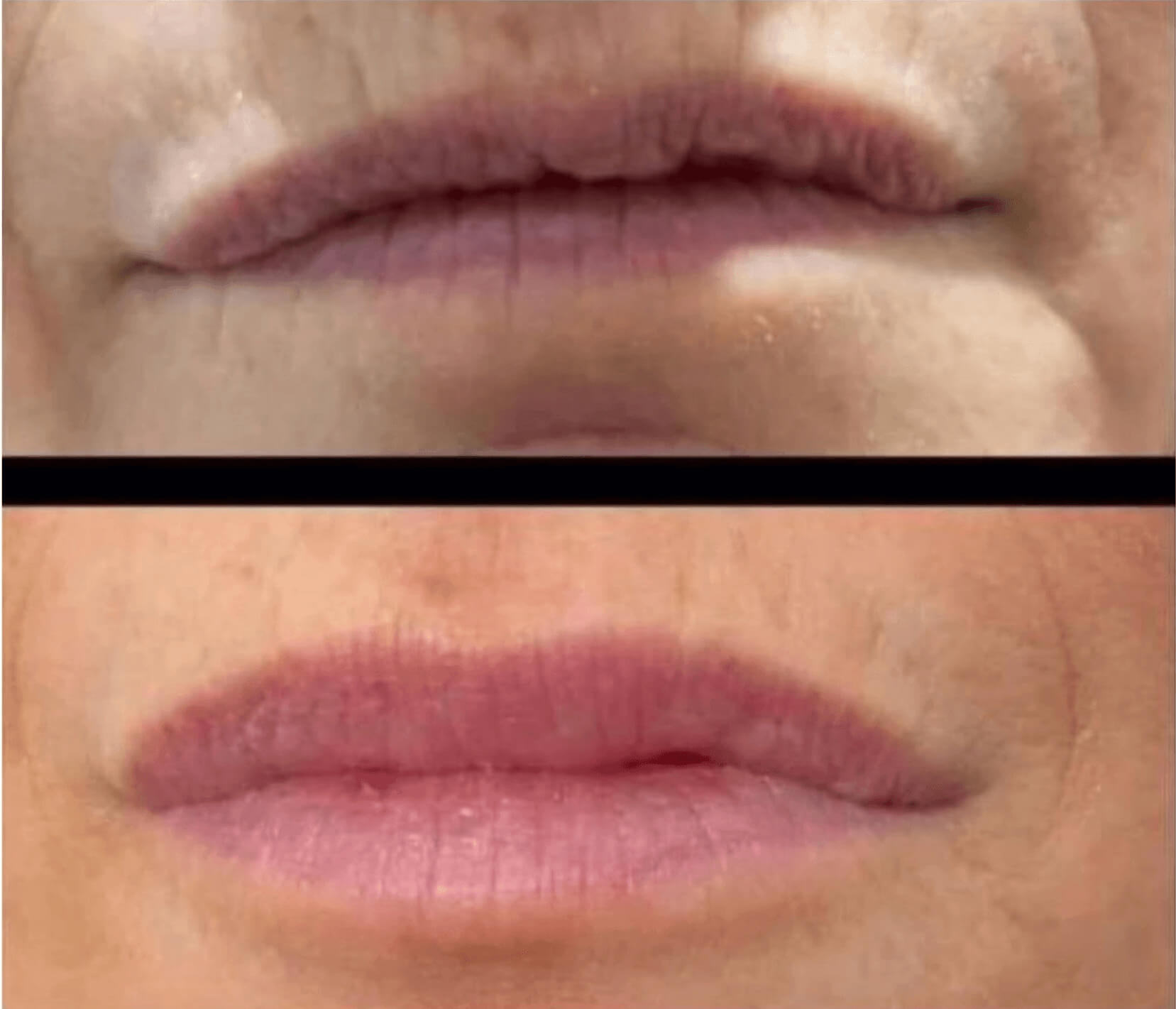 efekt przed i po dla zbiegu medycyny estetycznej dla ust