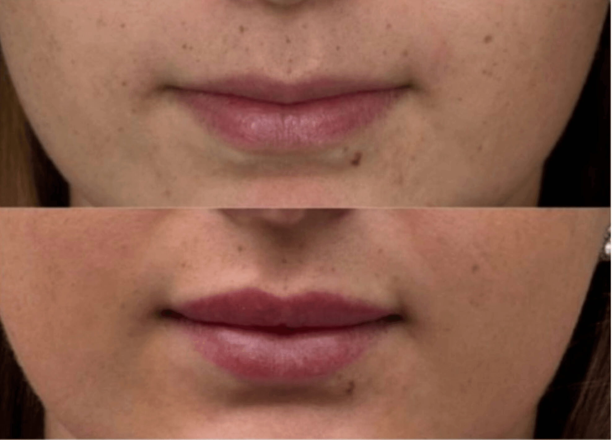 efekt przed i po dla zbiegu medycyny estetycznej dla ust