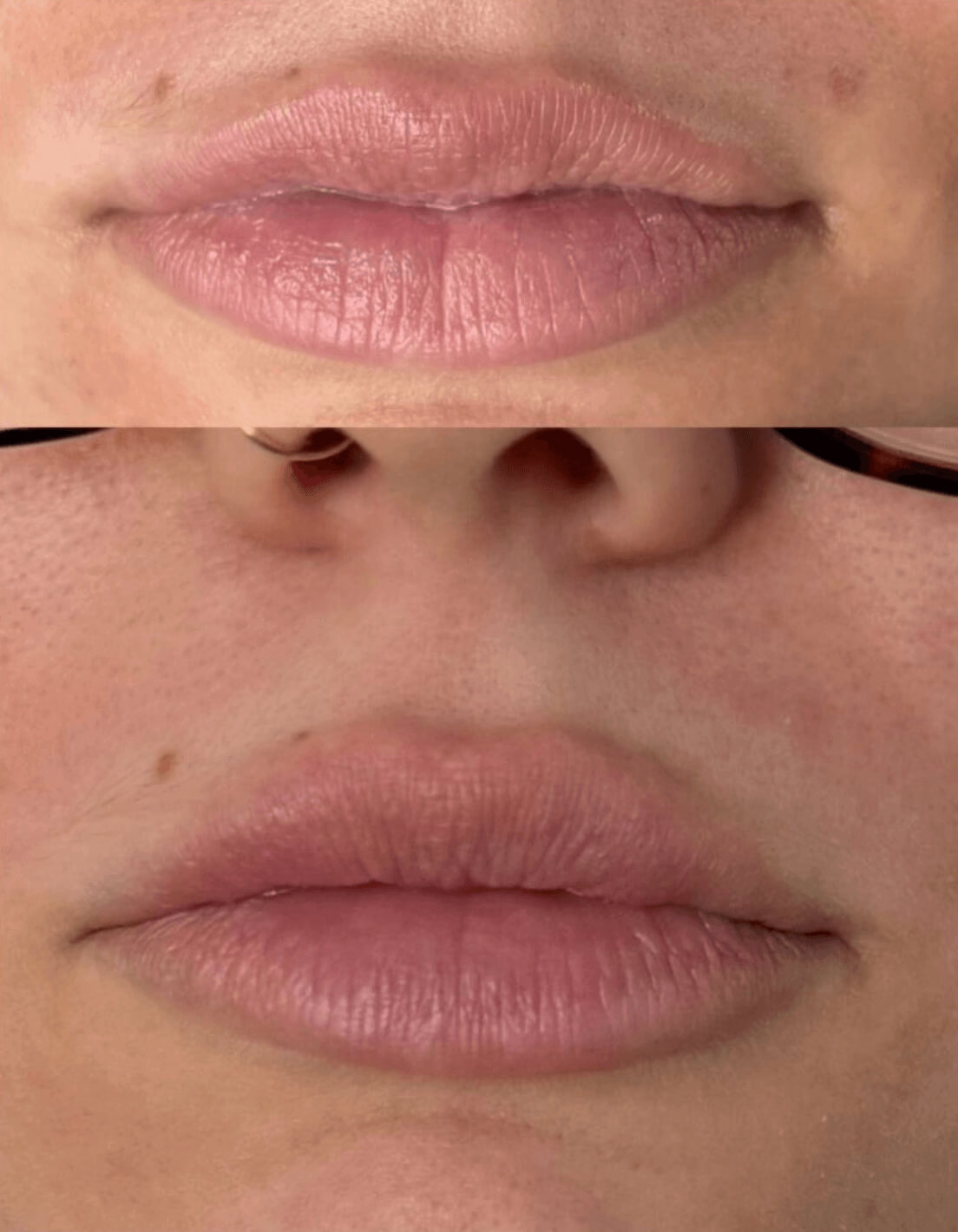 efekt przed i po dla zbiegu medycyny estetycznej dla ust
