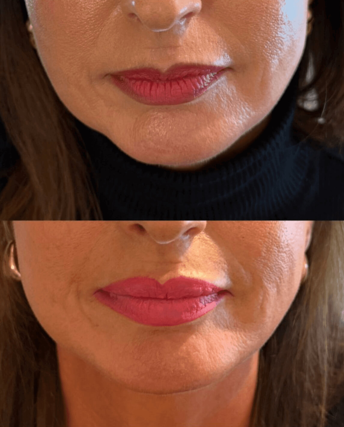 efekt przed i po dla zbiegu medycyny estetycznej dla ust