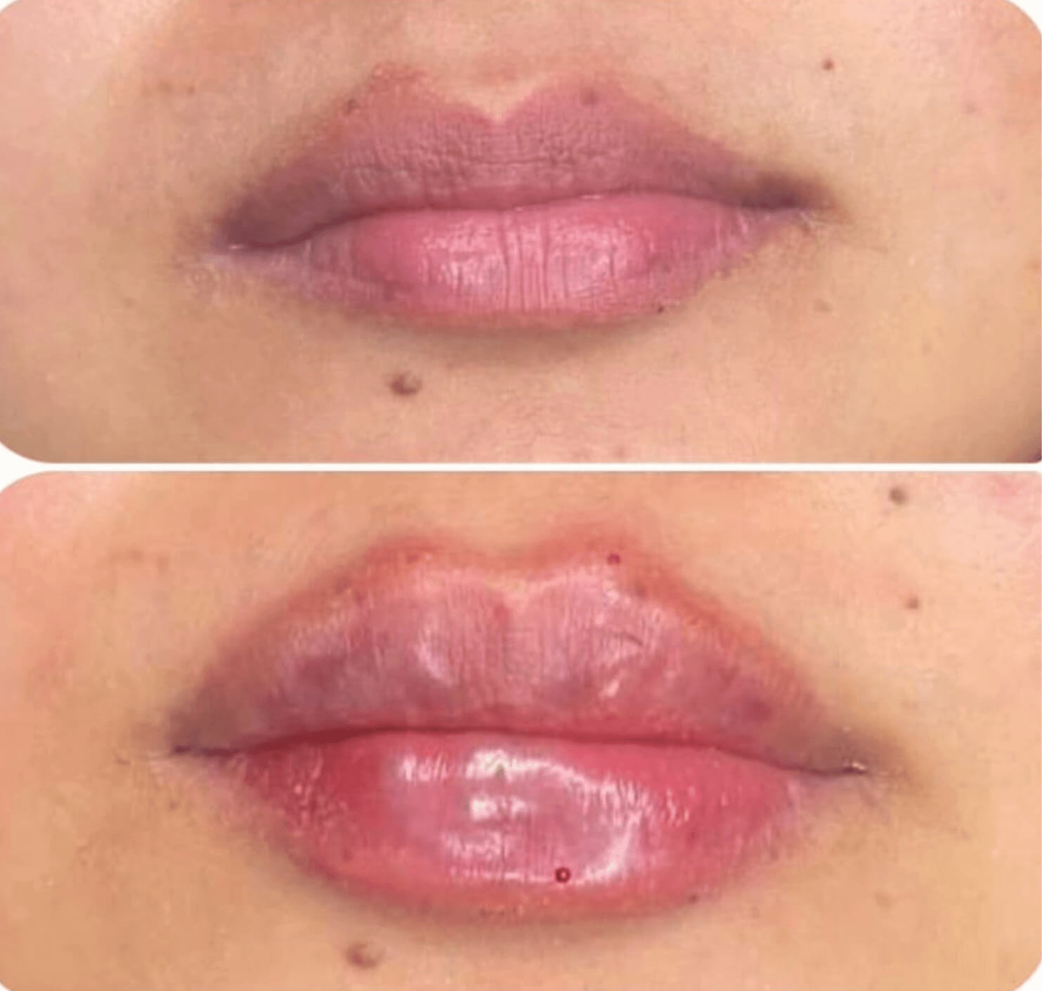 efekt przed i po dla zbiegu medycyny estetycznej dla ust