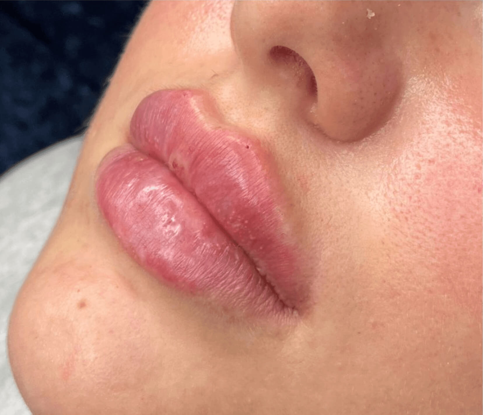 efekt medycyny estetycznej dla ust